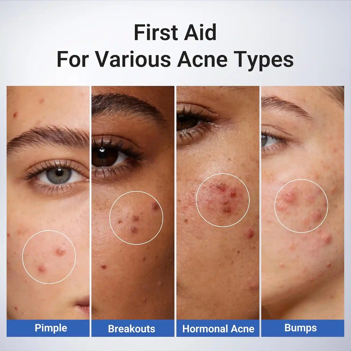 1.8% Salicylic Acid Acne Treatment – 24H Overnight Shrinkage For Clear Acne-Free Skin