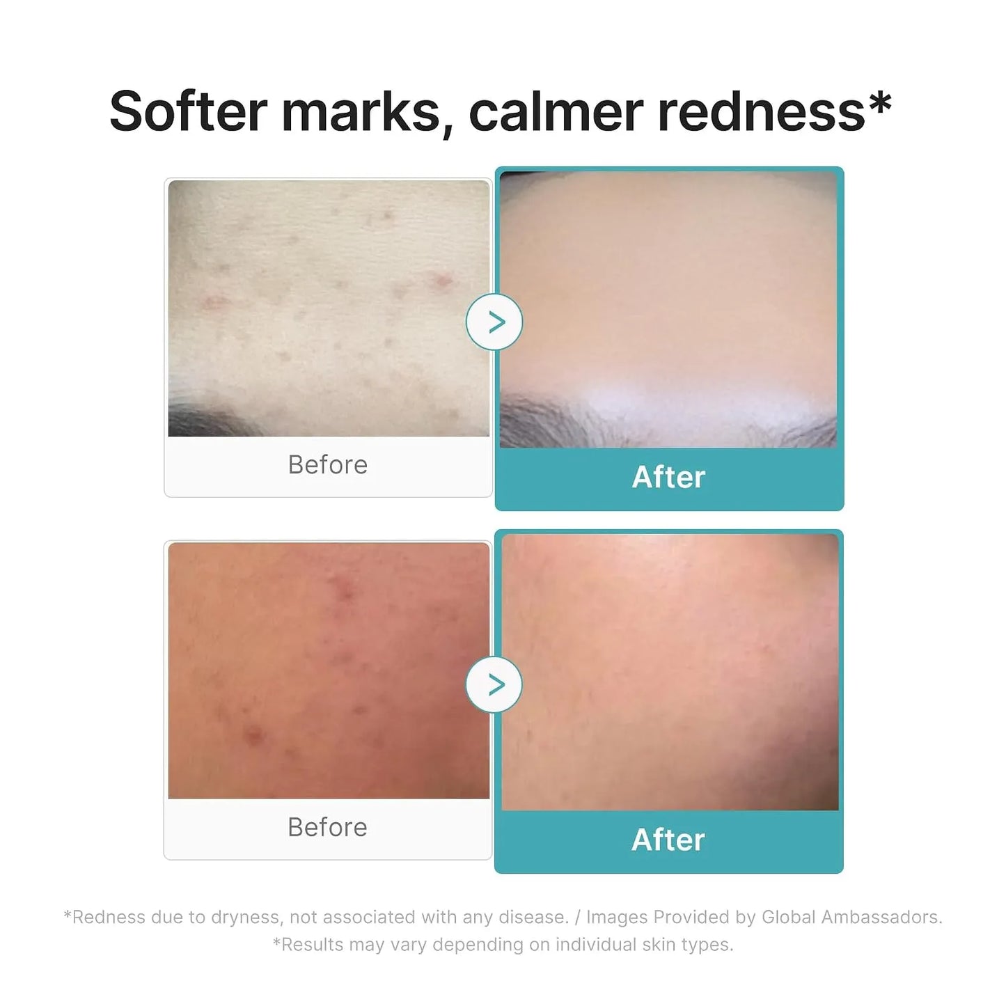 Azelaic Acid 10% Soothing Serum – Advanced Calming Formula For Redness & Post-Blemish Marks