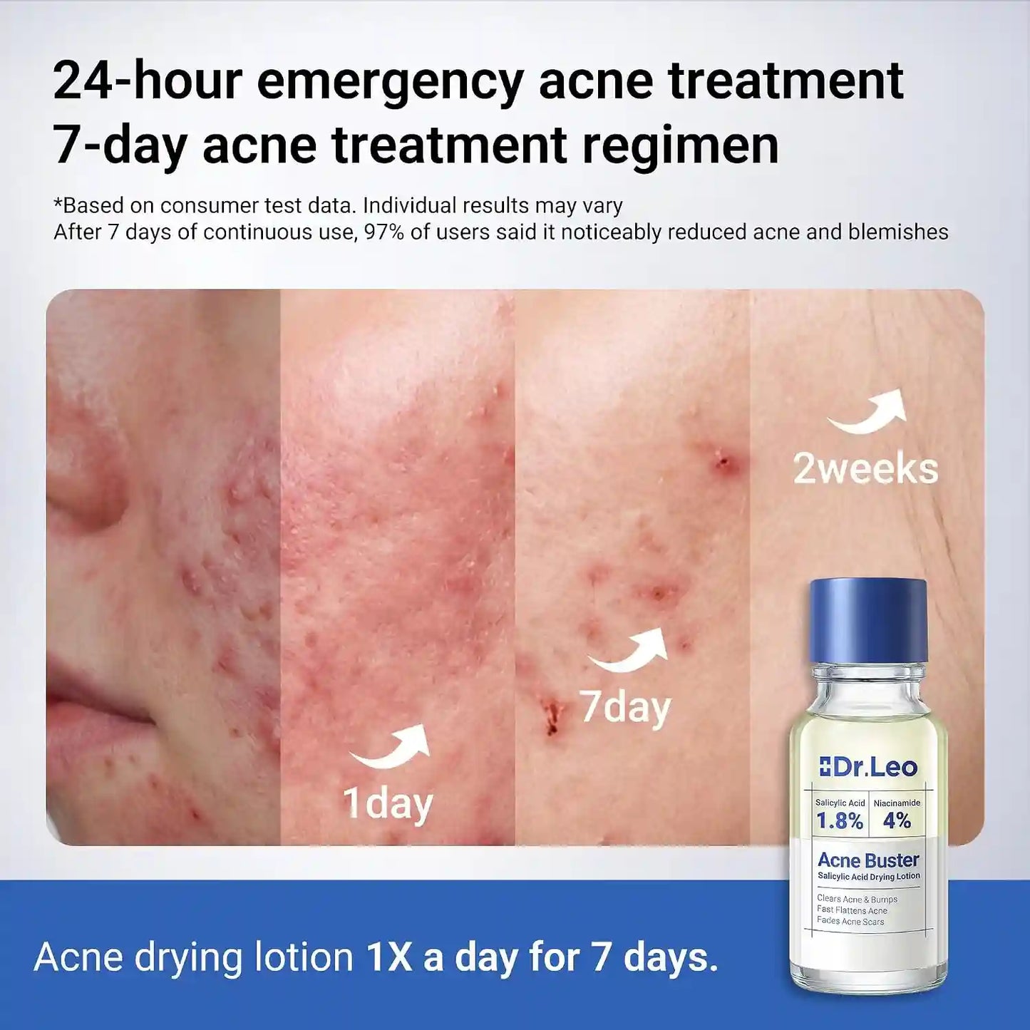 1.8% Salicylic Acid Acne Treatment – 24H Overnight Shrinkage For Clear Acne-Free Skin