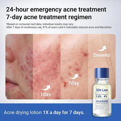 1.8% Salicylic Acid Acne Treatment – 24H Overnight Shrinkage For Clear Acne-Free Skin